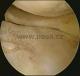 chondromalacie  (narušení kloubní chrupavky) ve vnitřní štěrbině kolenního kloubu, s ložisky obna