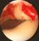 luxace pately (vykloubení čéšky) - prokrvácení mediálního retinakula a nesprávná artikulace femo2