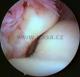 artroskopie loketního loubu - pohled na hlavičku radia (vřetenní kosti)