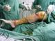 artroskopie kolenního a hlezenného kloubu současně (náhrada chrupavky v hleznu chrupavkou z kolen