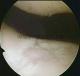 chondromalacie  (narušení kloubní chrupavky) ve femoropatelární štěrbině kolenního kloubu, s loži