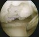 chondromalacie  (narušení kloubní chrupavky) ve vnitřní štěrbině kolenního kloubu, s ložiskem obn