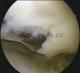 chondromalacie  (narušení kloubní chrupavky) ve vnitřní štěrbině kolenního kloubu, s odchlpujícím
