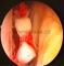 luxace pately (vykloubení čéšky) - odlomené kousky chrupavky v kloubu