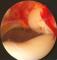 luxace pately (vykloubení čéšky) - prokrvácení mediálního retinakula a nesprávná artikulace femor
