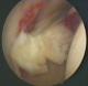 artroskopie kyčelného kloubu volné kousky chrupavky po luxaci kyčelného kloubu
